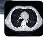 Illustrative CT scan